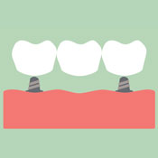Illustration of dental crown