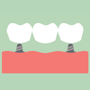 dental bridge illustration