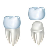 Illustration of dental crown