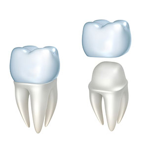 Veneers and Crowns at Fine Dentistry