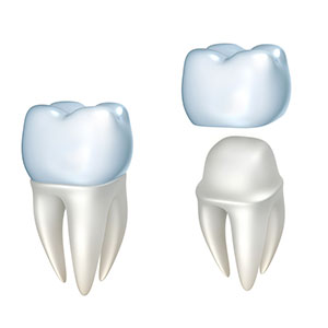 Illustration of dental crown