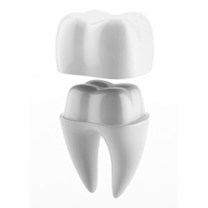 Illustration of dental crown