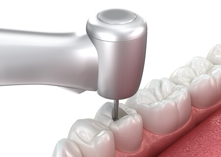 Dental drill on a molar