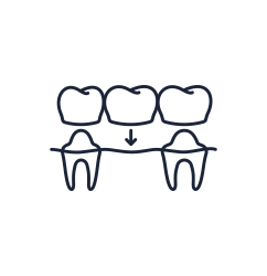 Illustration of dental bridge