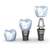Illustration of dental implant