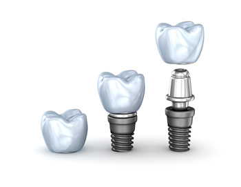 Illustration of dental implant