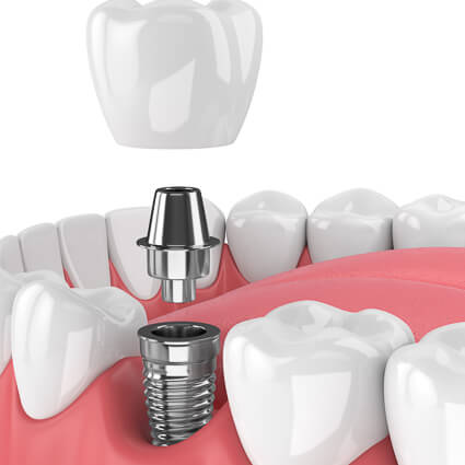 illustration of a dental implant