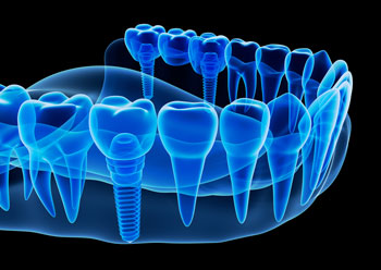 Illustration of an x-rayed dental implant