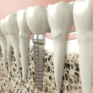 Illustration of dental implant