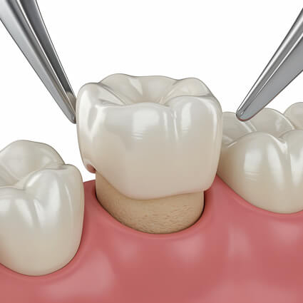Dental crown illustration