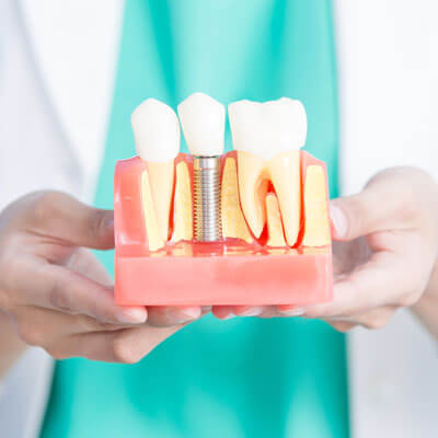 Dentist holding model of a tooth replacement