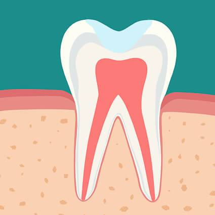 model of an endodontic treatment on a tooth