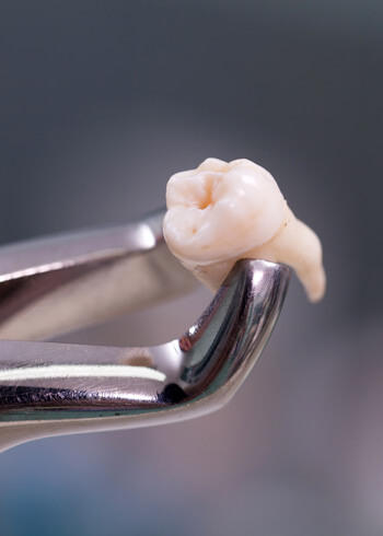 Extracted tooth