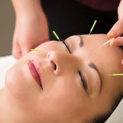 acupuncture needles in a persons face