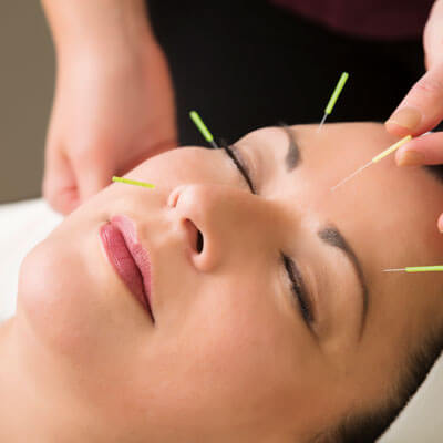 woman with acupuncture needles on forehead