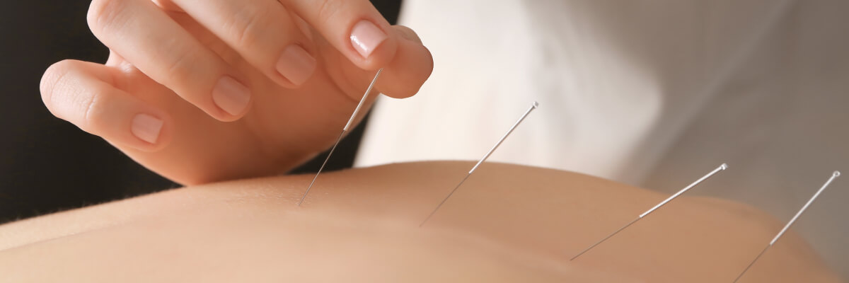 Acupuncture on back