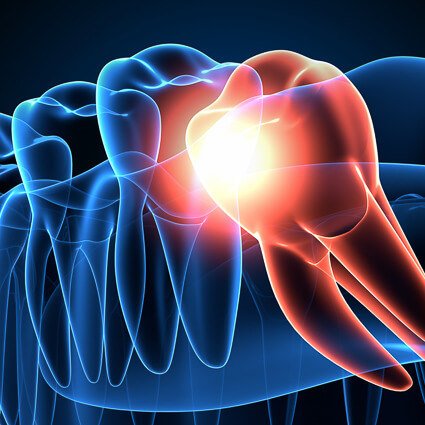 Wisdom teeth illustration
