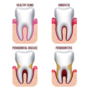 Illustration of the stages of gum disease