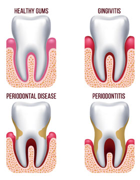 Illustration of periodontal disease