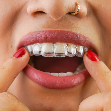 person putting clear aligner in their mouth