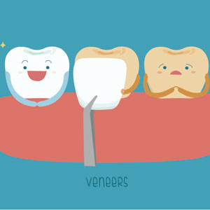 Illustration of dental veneer