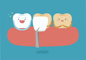 Illustration of dental veneer