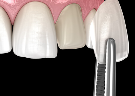 Dental Veneers illustration