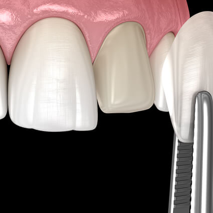 Holding beneer for replacement