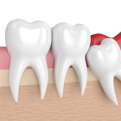 illustration of wisdom tooth crowding
