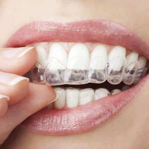 Woman inserting clear aligners