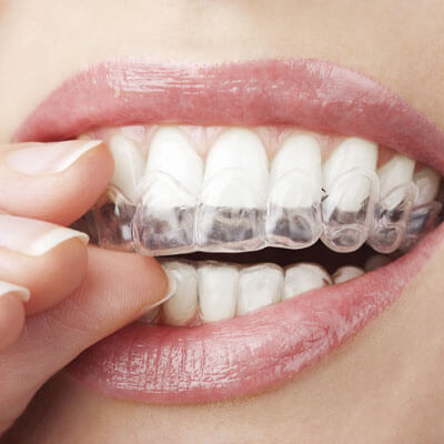 woman inserting clear aligners on to her teeth