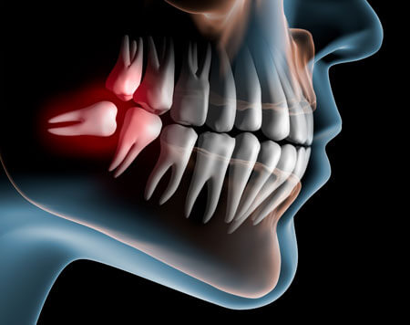 jaw wisdom tooth