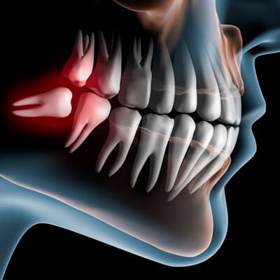 model of wisdom teeth in jaw