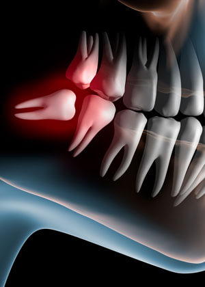 Wisdom teeth illustration