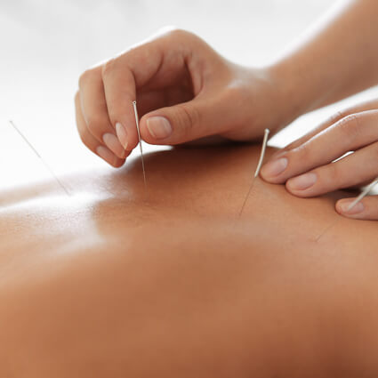 applying acupuncture needles
