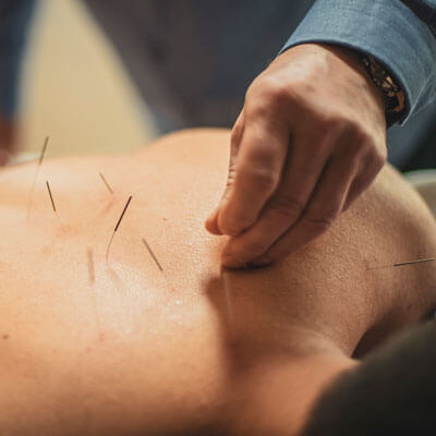 Applying acupuncture needles