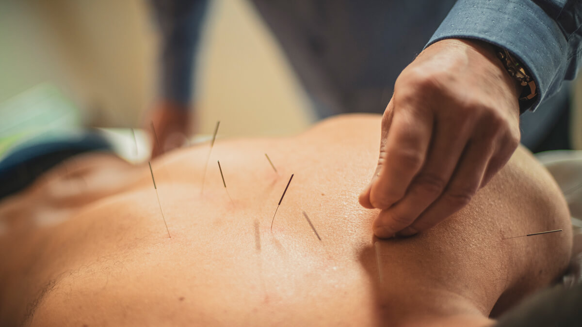 Applying acupuncture needles to back