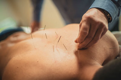 Applying acupuncture needles to back