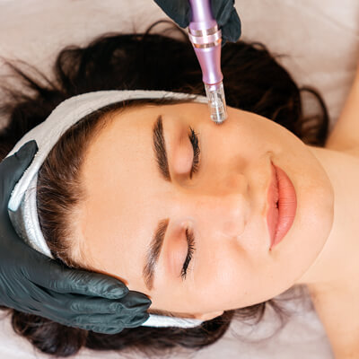 microneedling on cheek