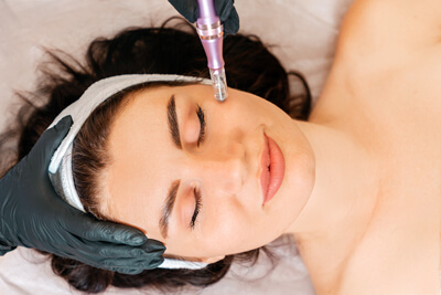Micro Needling treatment to woman's face