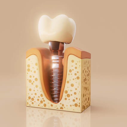 model of dental implant