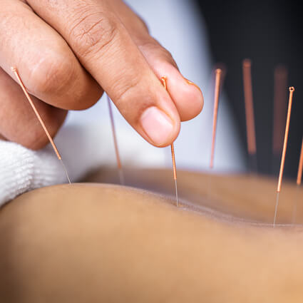 Acupuncture needles in skin