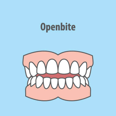 openbite illustration