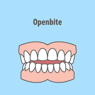 openbite