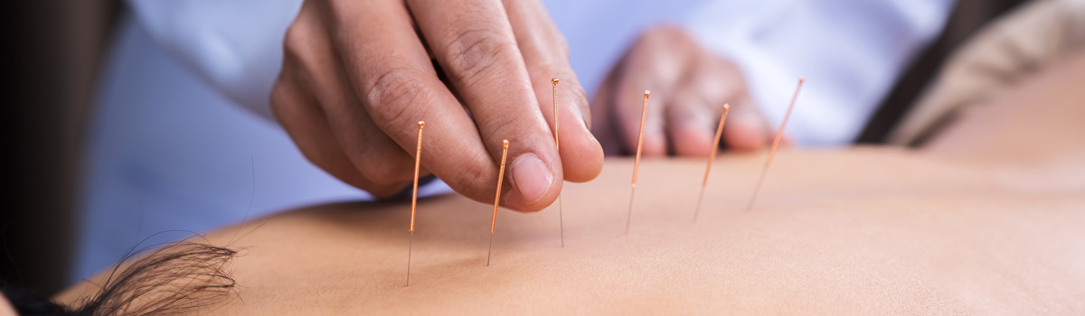 Acupuncture needles applied to patient's back
