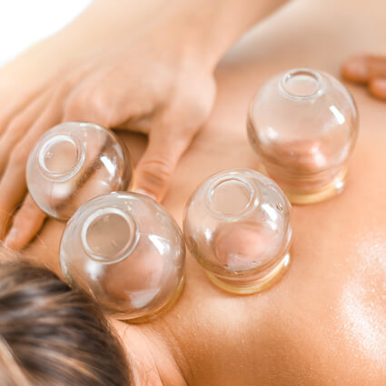 cupping therapy on womans back
