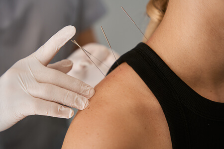 acupuncture on womans shoulder