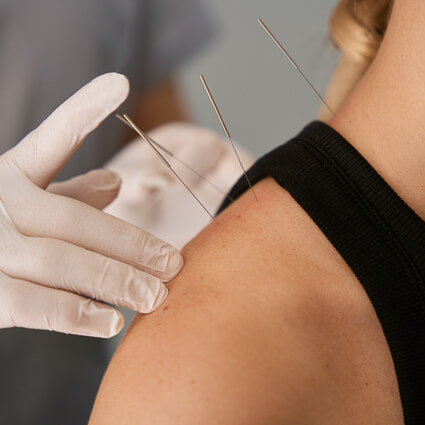 Practitioner placing acupuncture needles in shoulder