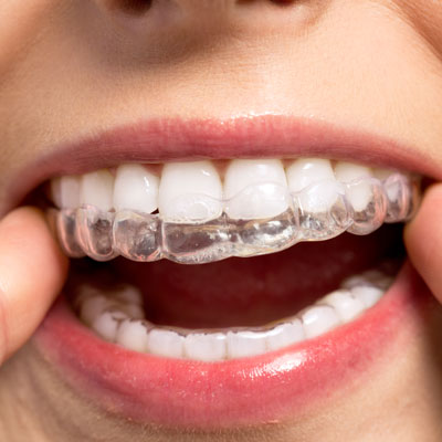 Woman inserting aligner in mouth