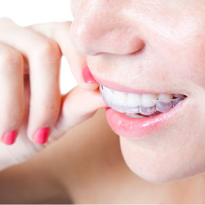 woman inserting invisble aligners